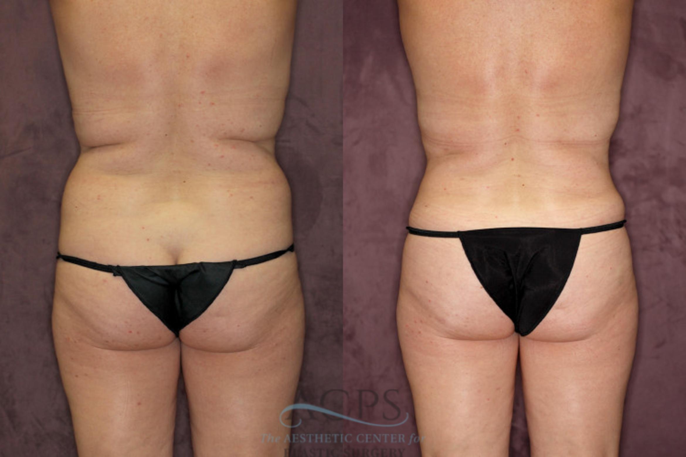 Before & After Liposuction Case 56 Rear View: View in Houston, TX