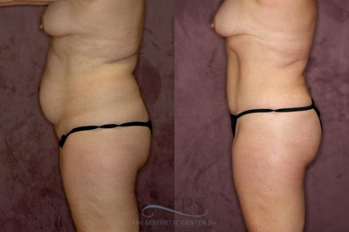 Before & After Liposuction Case 56 Side Left View: View in Houston, TX