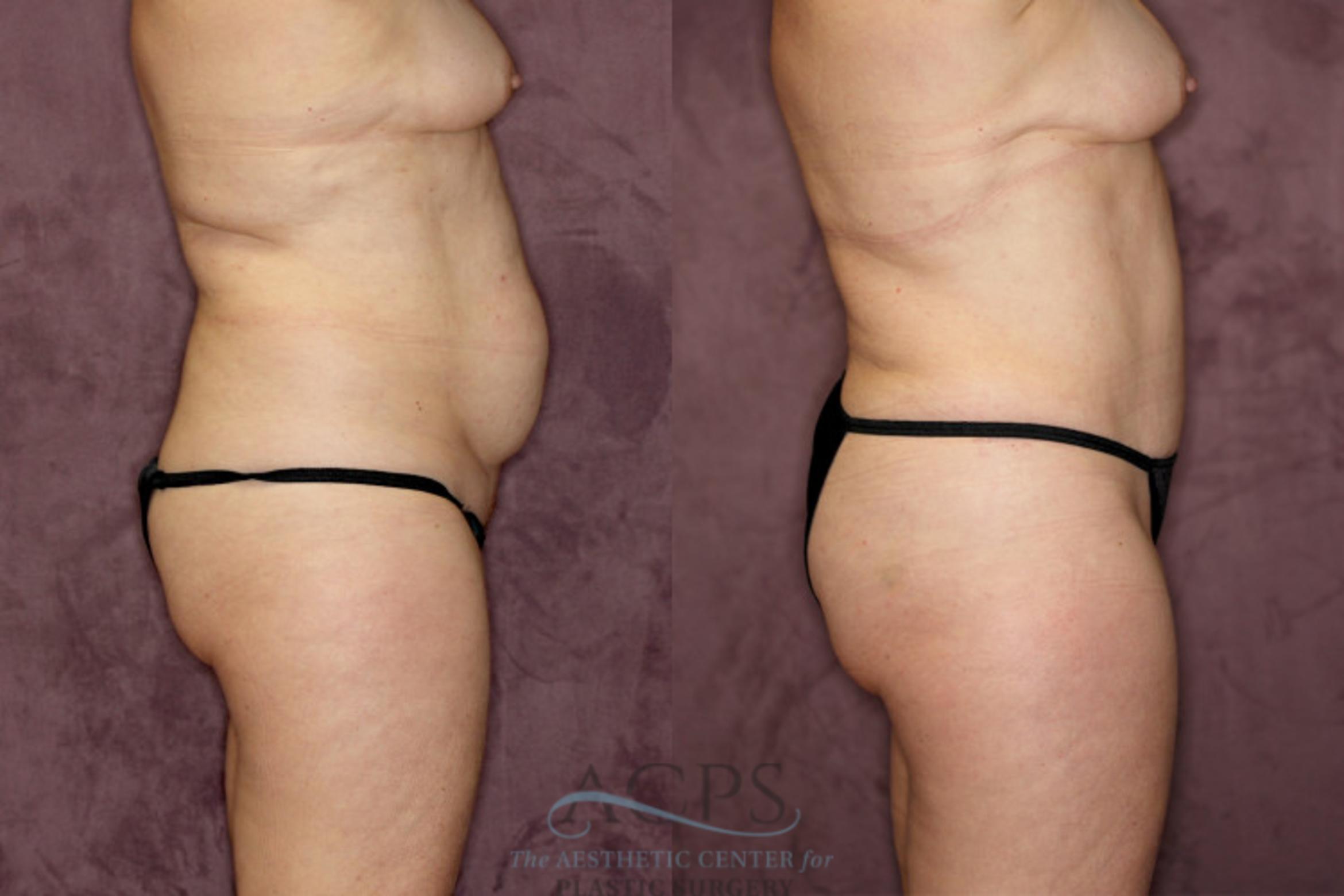 Before & After Liposuction Case 56 Side Right View: View in Houston, TX