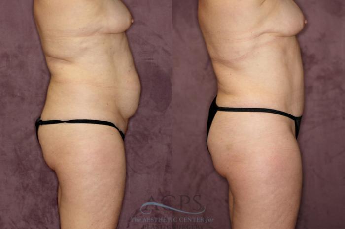 Before & After Liposuction Case 56 Side Right View: View in Houston, TX