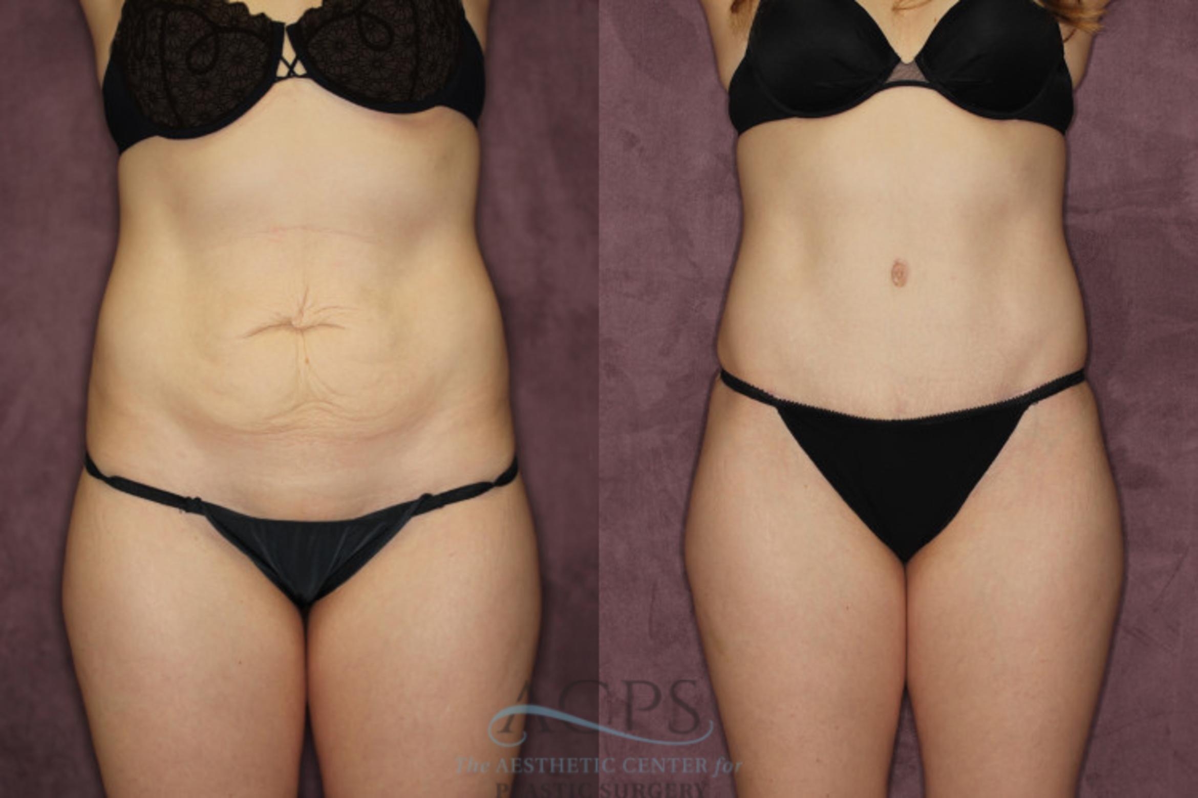 Before & After Liposuction Case 57 Front View: View in Houston, TX