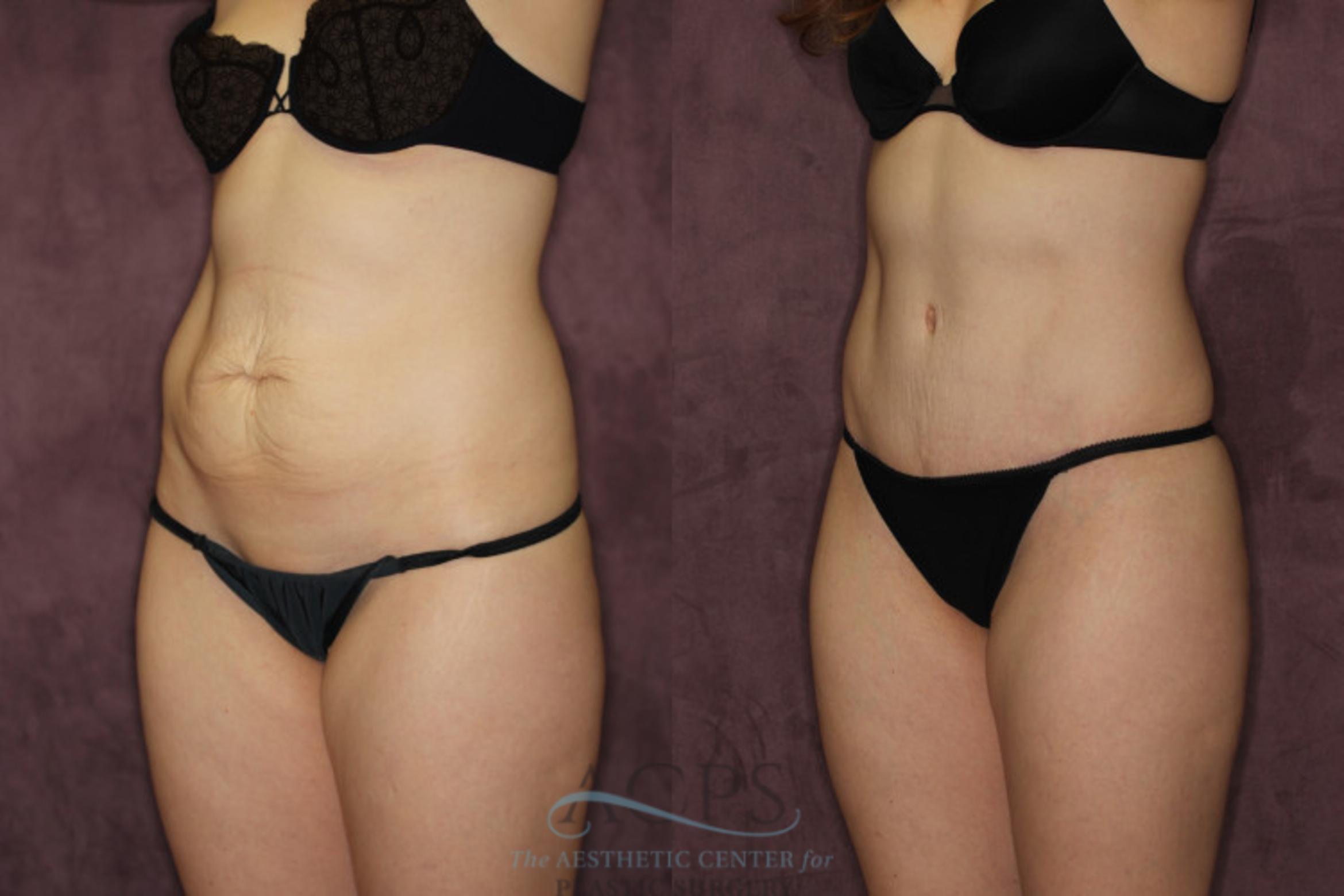 Before & After Liposuction Case 57 Oblique Left View: View in Houston, TX