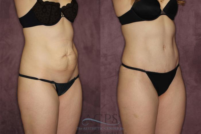 Before & After Liposuction Case 57 Oblique Right View: View in Houston, TX