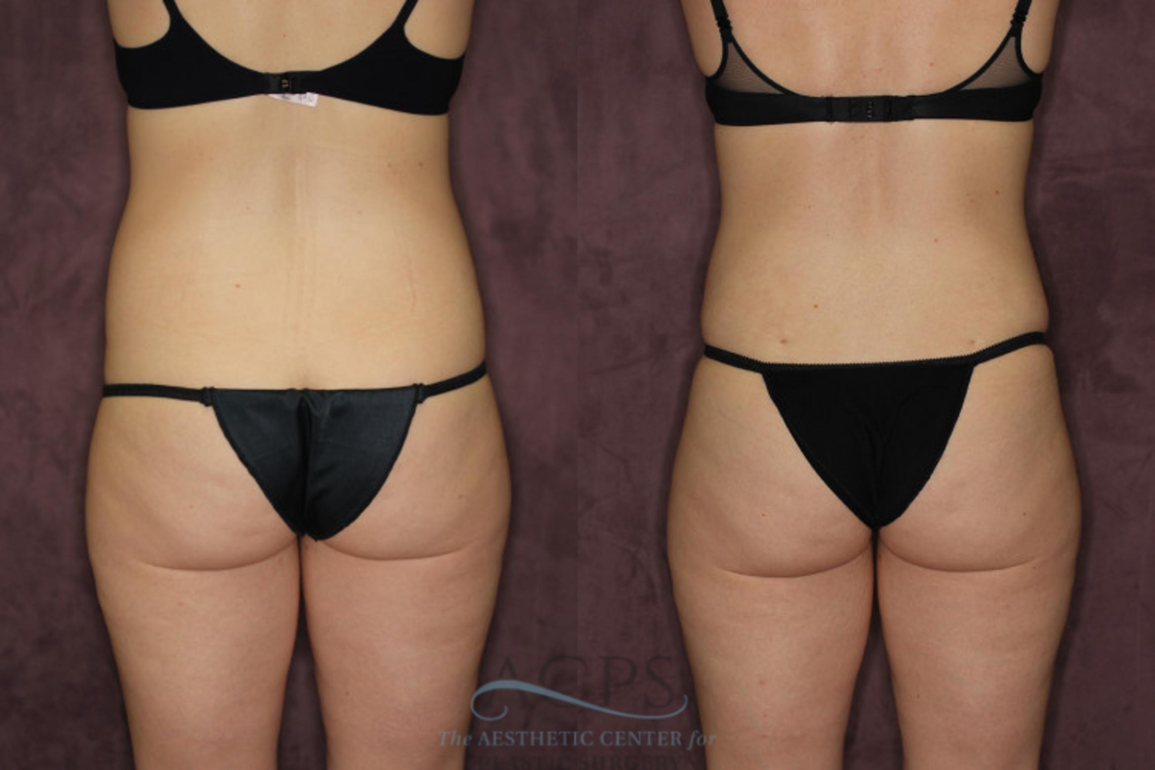 Before & After Liposuction Case 57 Rear View: View in Houston, TX