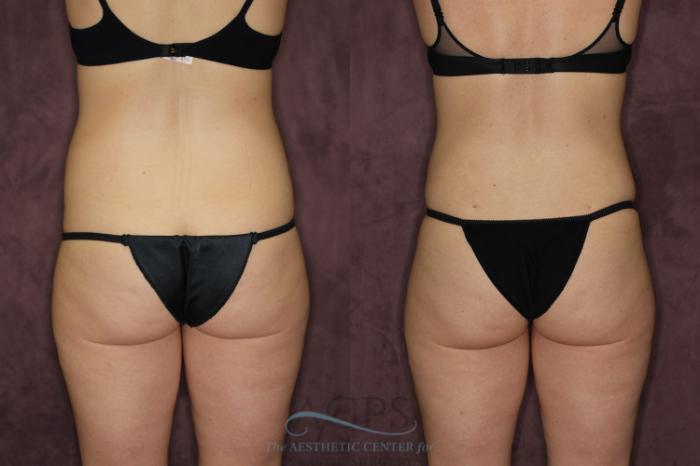 Before & After Liposuction Case 57 Rear View: View in Houston, TX