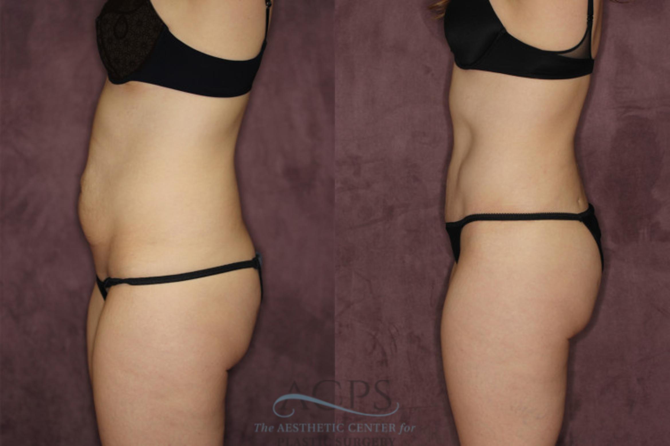 Before & After Liposuction Case 57 Side Left View: View in Houston, TX