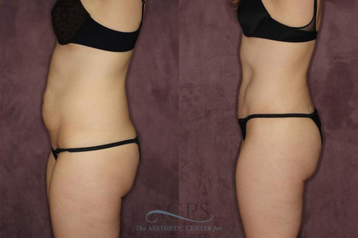 Before & After Liposuction Case 57 Side Left View: View in Houston, TX