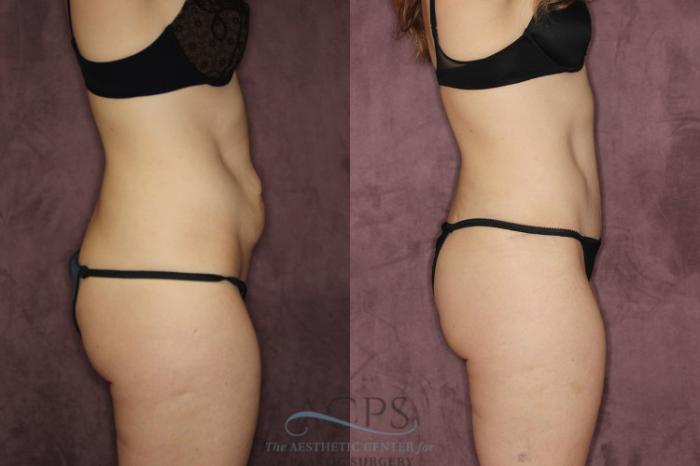 Before & After Liposuction Case 57 Side Right View: View in Houston, TX