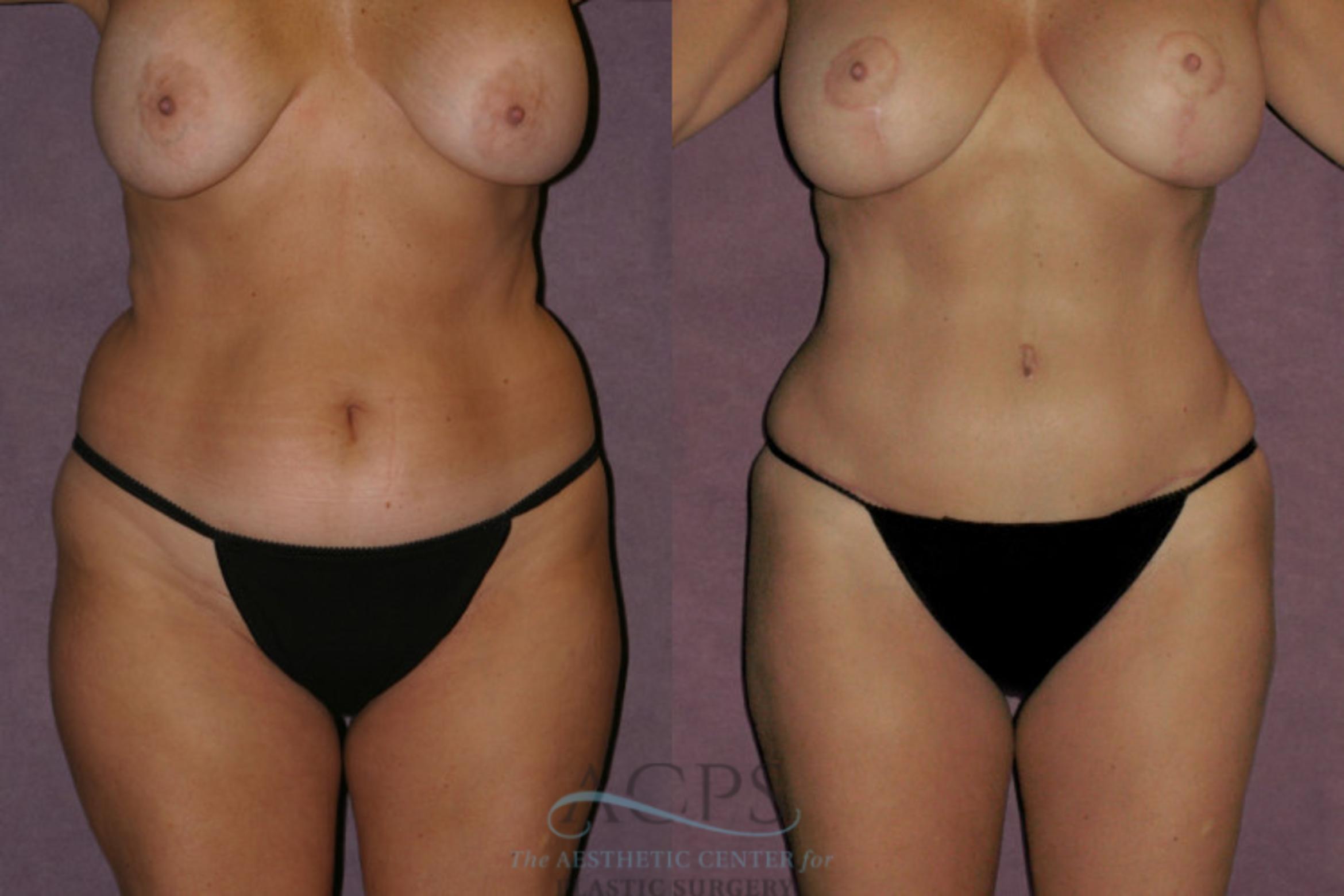 Before & After Tummy Tuck Case 58 Front View: View in Houston, TX