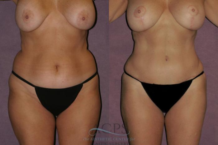 Before & After Tummy Tuck Case 58 Front View: View in Houston, TX