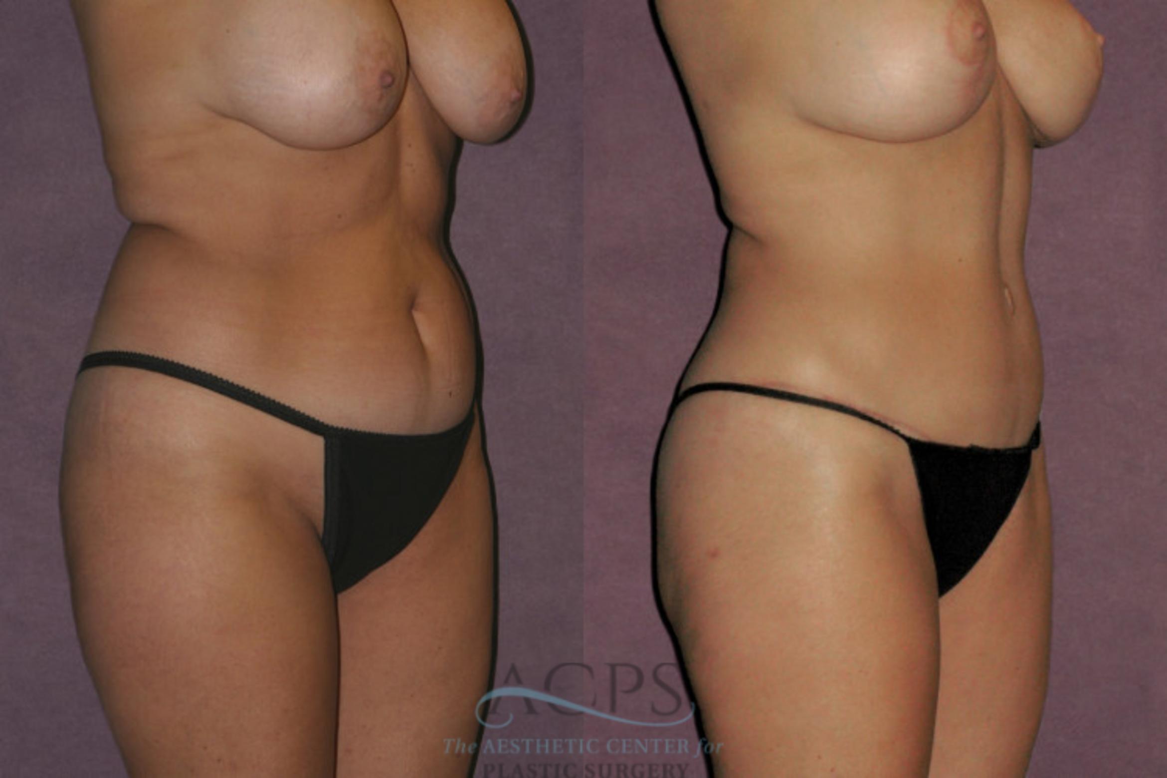 Before & After Tummy Tuck Case 58 Oblique Right View: View in Houston, TX
