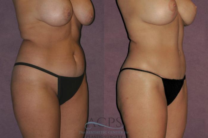 Before & After Tummy Tuck Case 58 Oblique Right View: View in Houston, TX