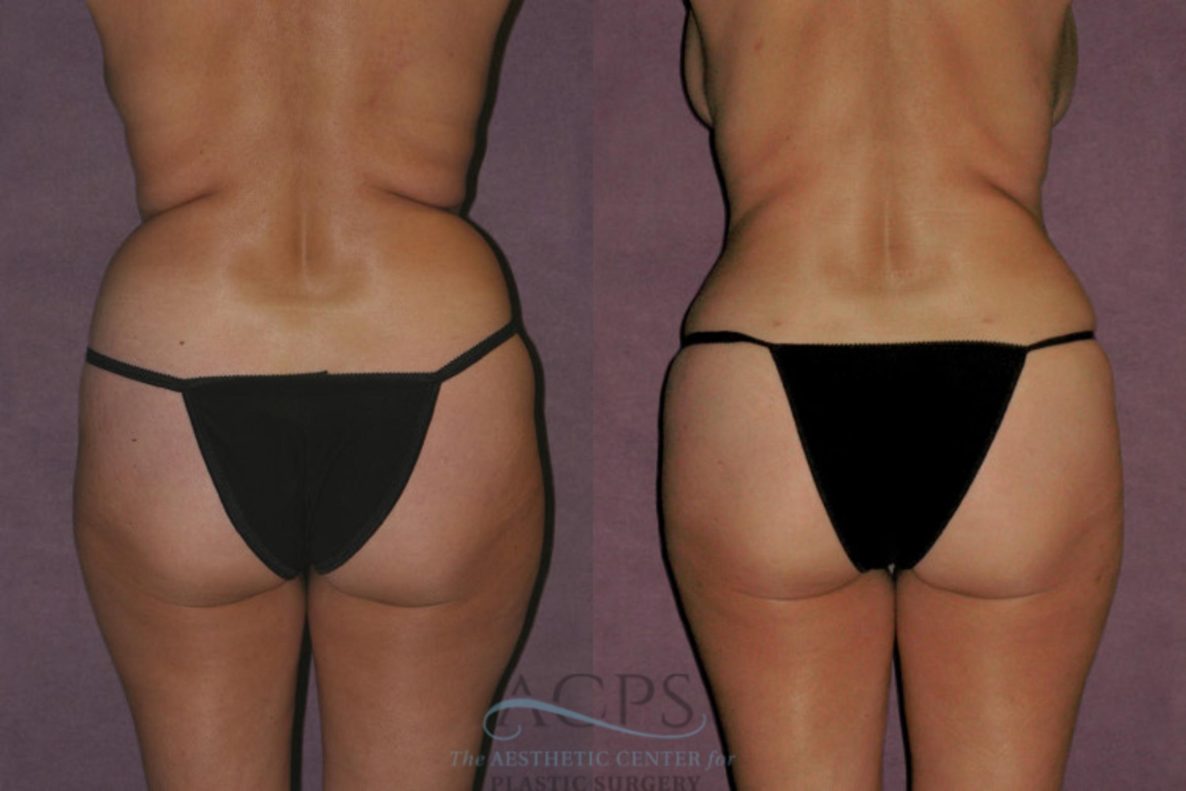 Before & After Tummy Tuck Case 58 Rear View: View in Houston, TX