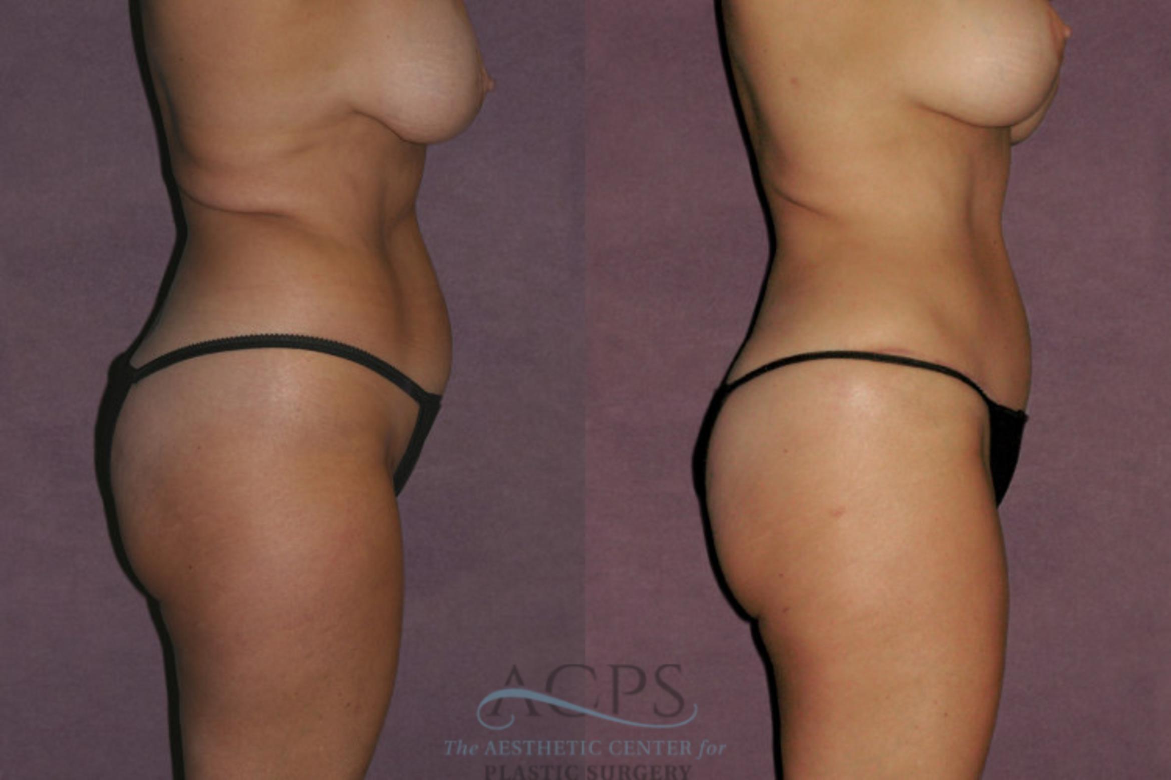 Before & After Tummy Tuck Case 58 Side Right View: View in Houston, TX