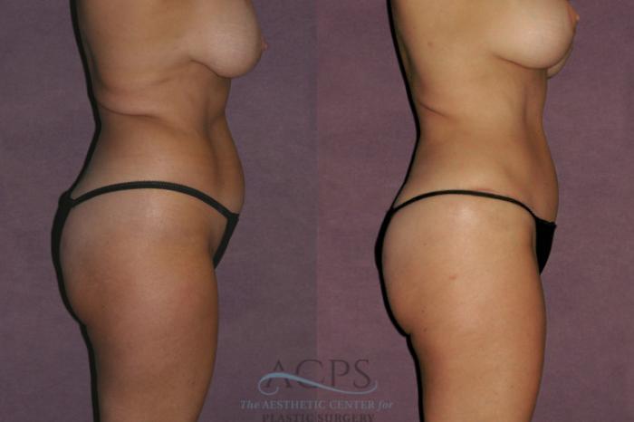 Before & After Tummy Tuck Case 58 Side Right View: View in Houston, TX