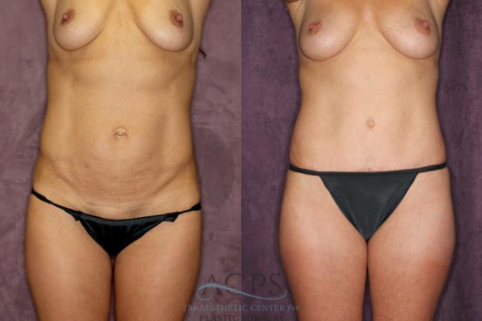 Before & After Tummy Tuck Case 59 Front View: View in Houston, TX