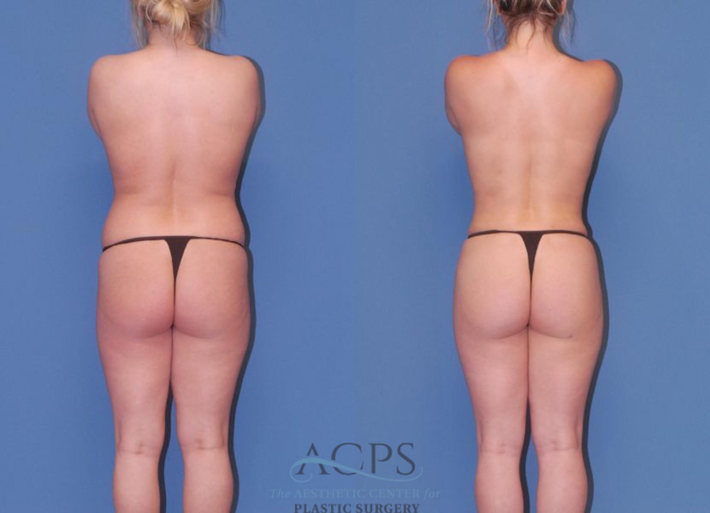Before & After Tummy Tuck Case 6 Rear View: View in Houston, TX