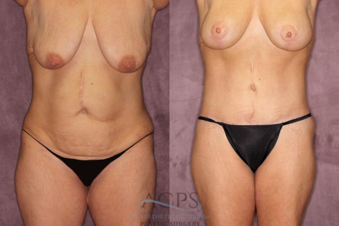 Before & After Tummy Tuck Case 60 Front View: View in Houston, TX