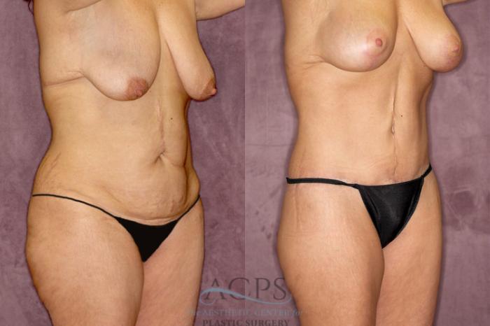 Before & After Tummy Tuck Case 60 Oblique Right View: View in Houston, TX