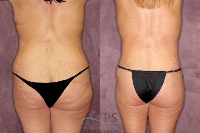 Before & After Tummy Tuck Case 60 Rear View: View in Houston, TX