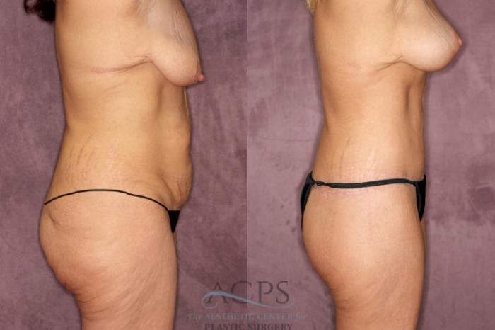 Before & After Tummy Tuck Case 60 Side Right View: View in Houston, TX