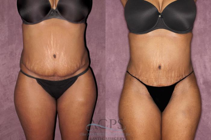 Before & After Liposuction Case 61 Front View: View in Houston, TX