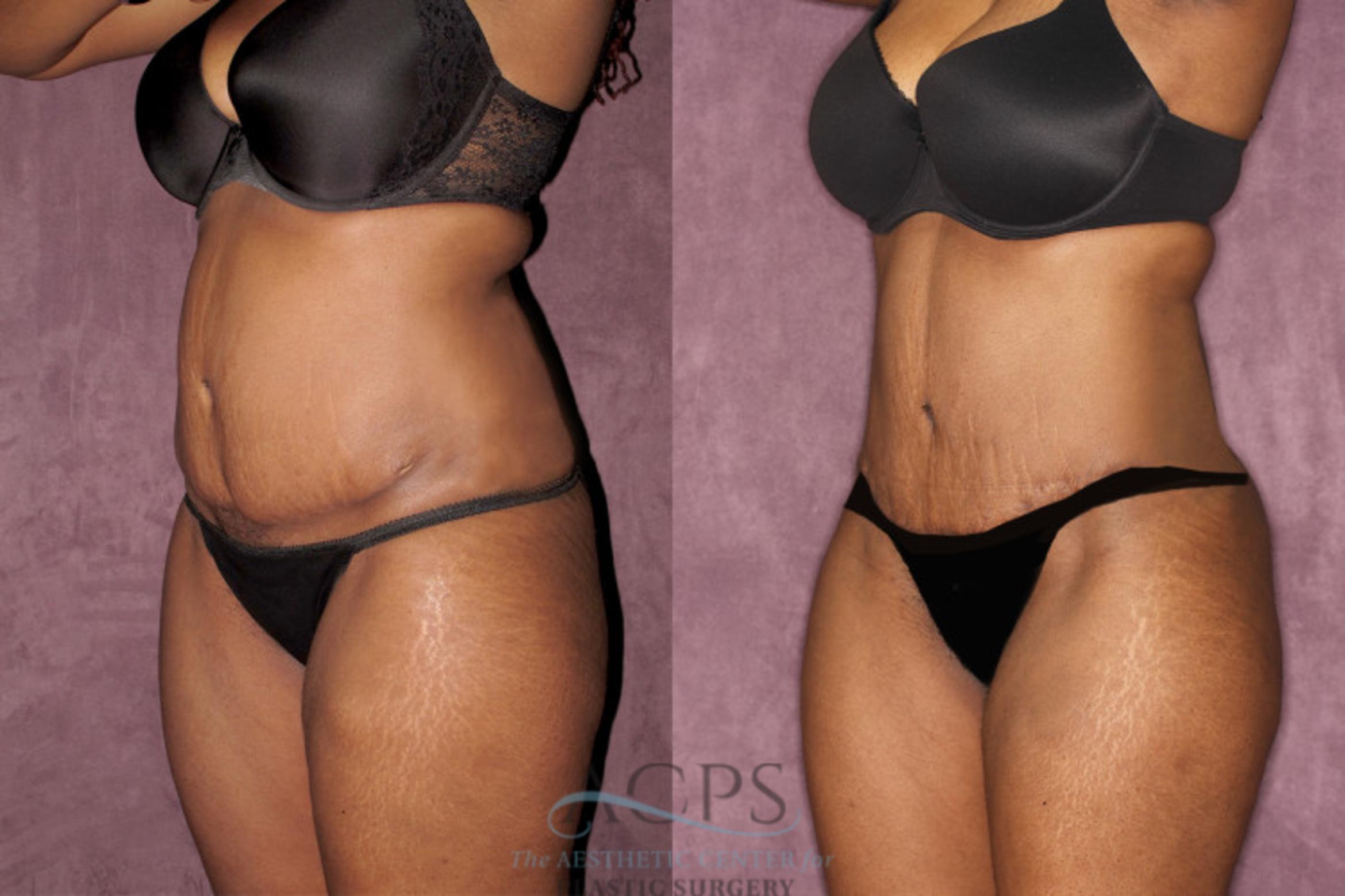 Before & After Liposuction Case 61 Oblique Left View: View in Houston, TX