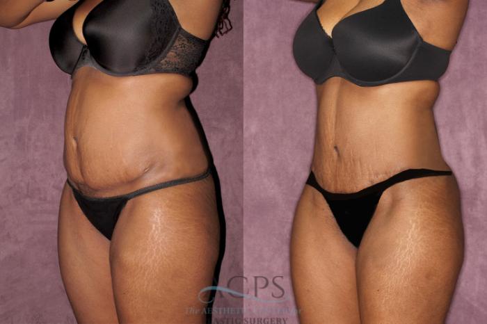 Before & After Liposuction Case 61 Oblique Left View: View in Houston, TX