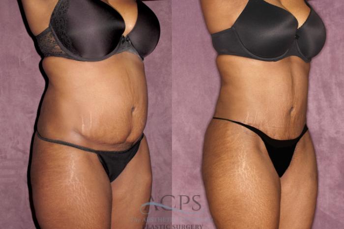 Before & After Liposuction Case 61 Oblique Right View: View in Houston, TX