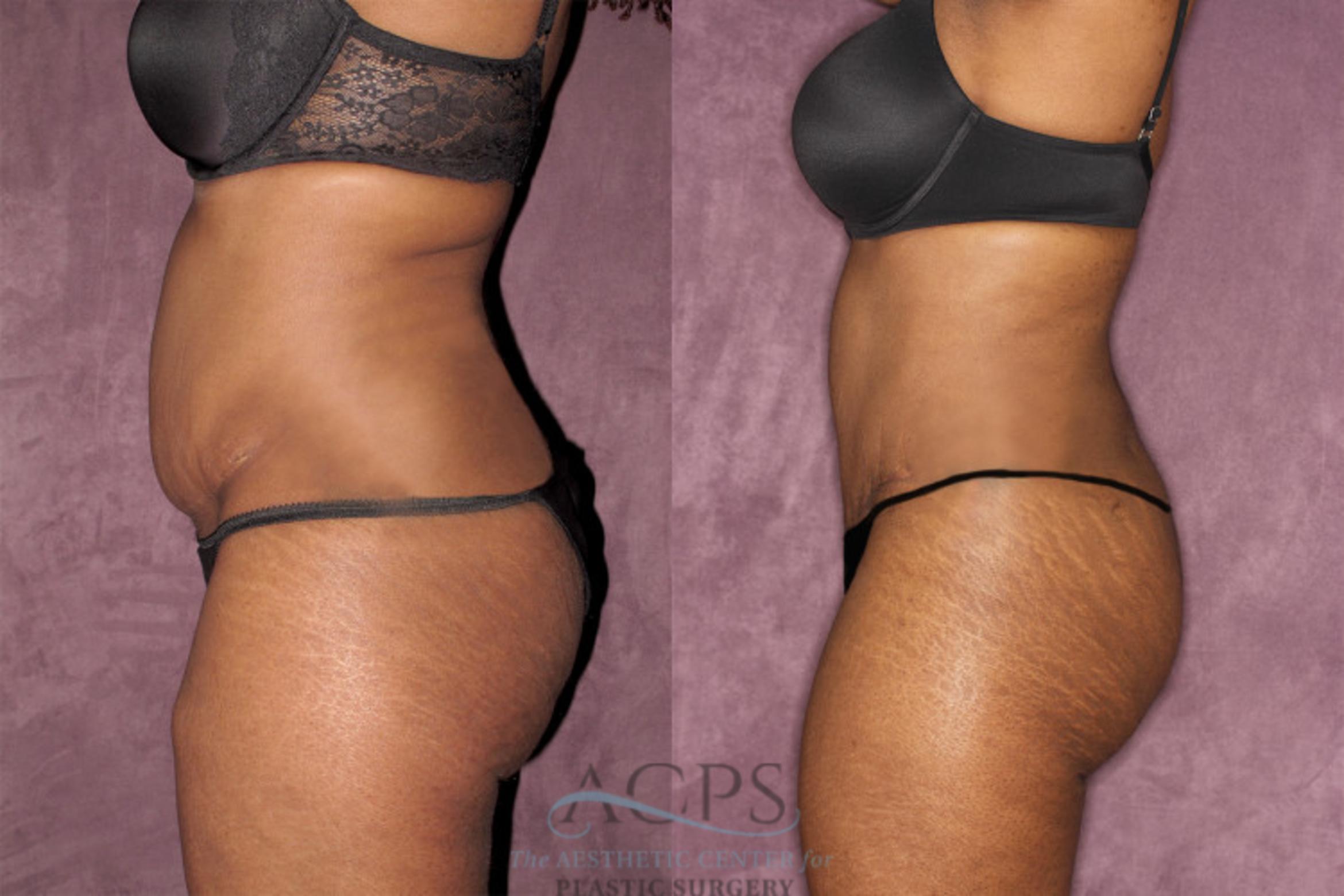 Before & After Liposuction Case 61 Side Left View: View in Houston, TX