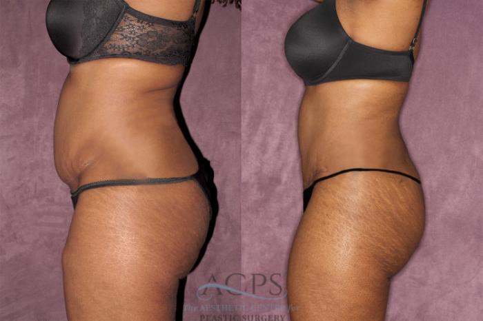 Before & After Liposuction Case 61 Side Left View: View in Houston, TX