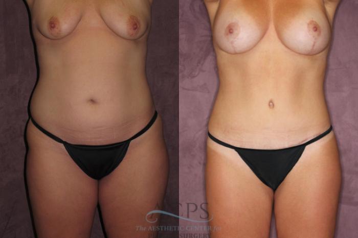 Before & After Tummy Tuck Case 62 Front View: View in Houston, TX