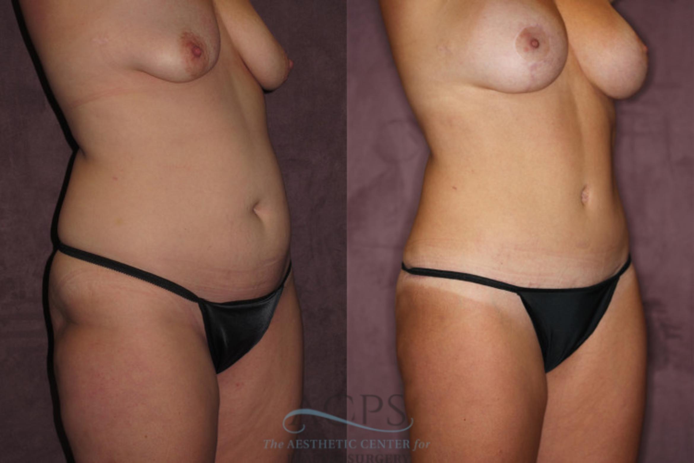 Before & After Tummy Tuck Case 62 Oblique Right View: View in Houston, TX