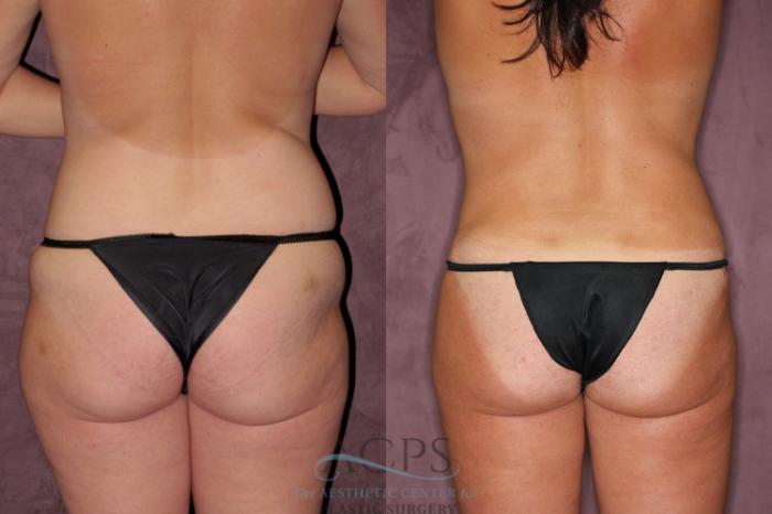 Before & After Tummy Tuck Case 62 Rear View: View in Houston, TX