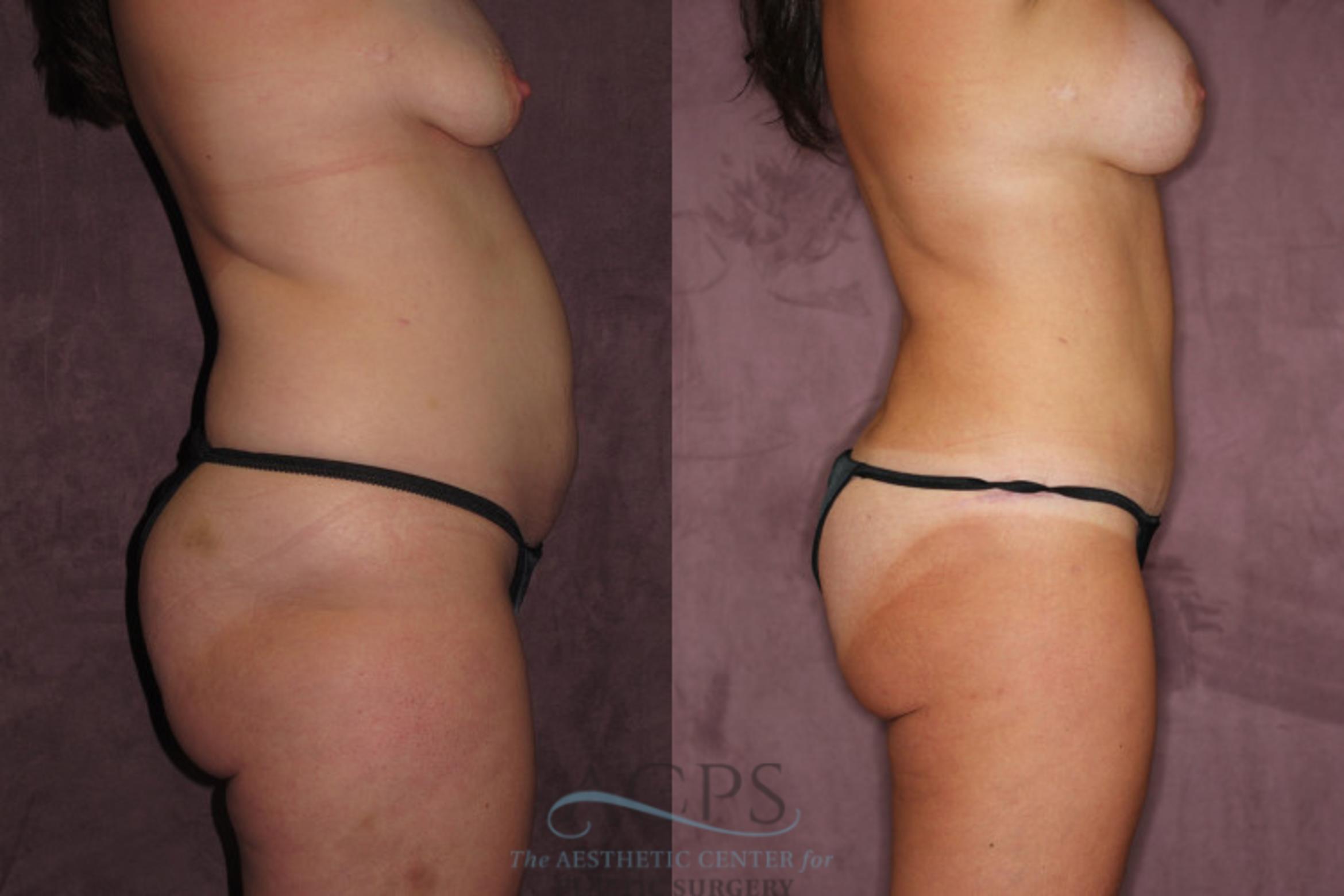 Before & After Tummy Tuck Case 62 Side Right View: View in Houston, TX