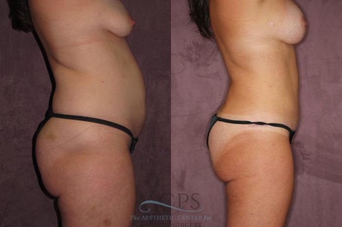 Before & After Tummy Tuck Case 62 Side Right View: View in Houston, TX