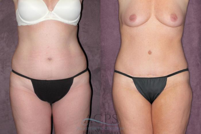Before & After Tummy Tuck Case 63 Front View: View in Houston, TX