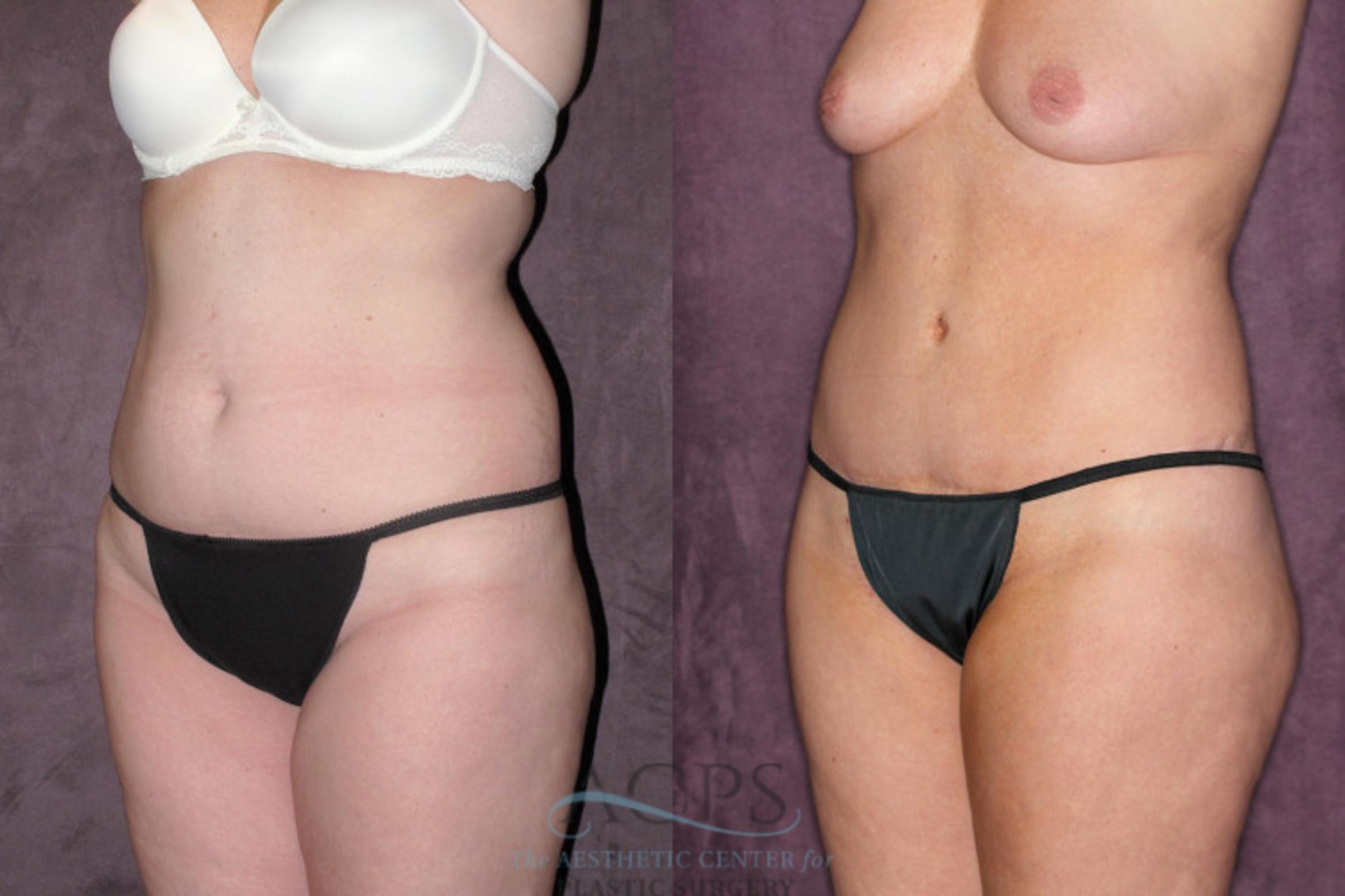 Before & After Tummy Tuck Case 63 Oblique Left View: View in Houston, TX