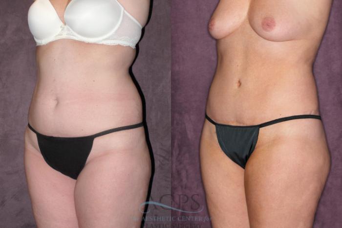 Before & After Tummy Tuck Case 63 Oblique Left View: View in Houston, TX