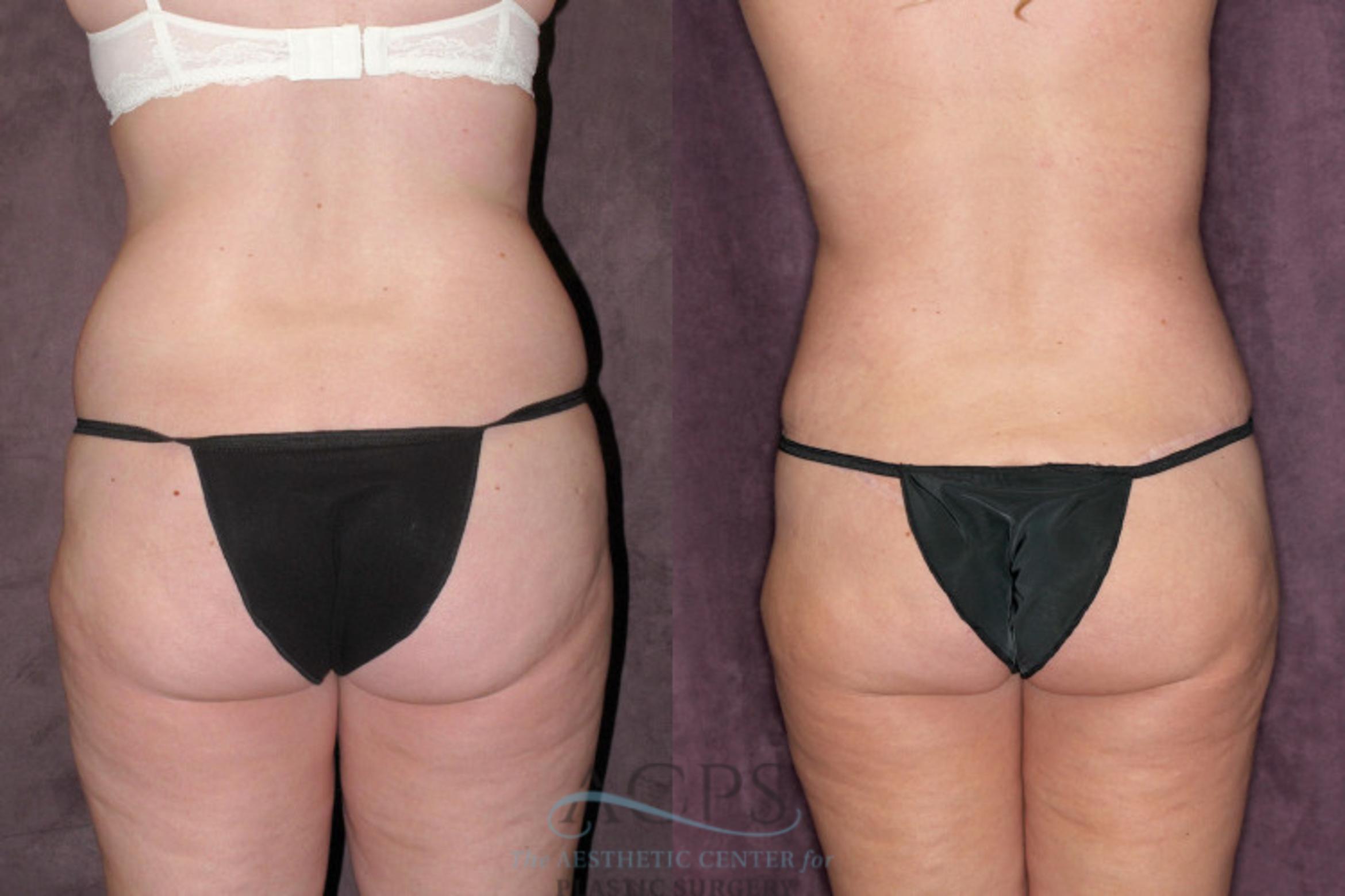 Before & After Tummy Tuck Case 63 Rear View: View in Houston, TX