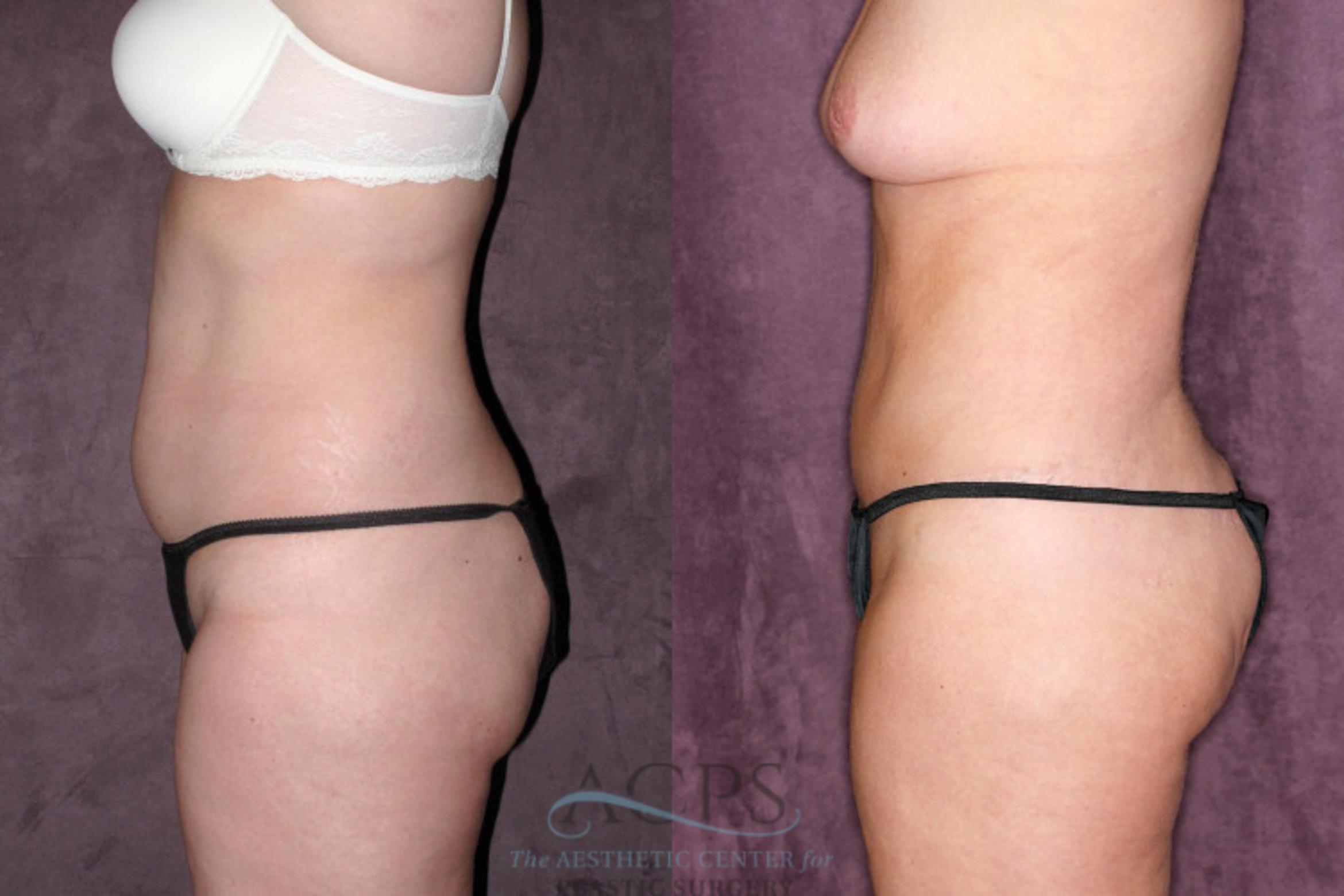 Before & After Tummy Tuck Case 63 Side Left View: View in Houston, TX