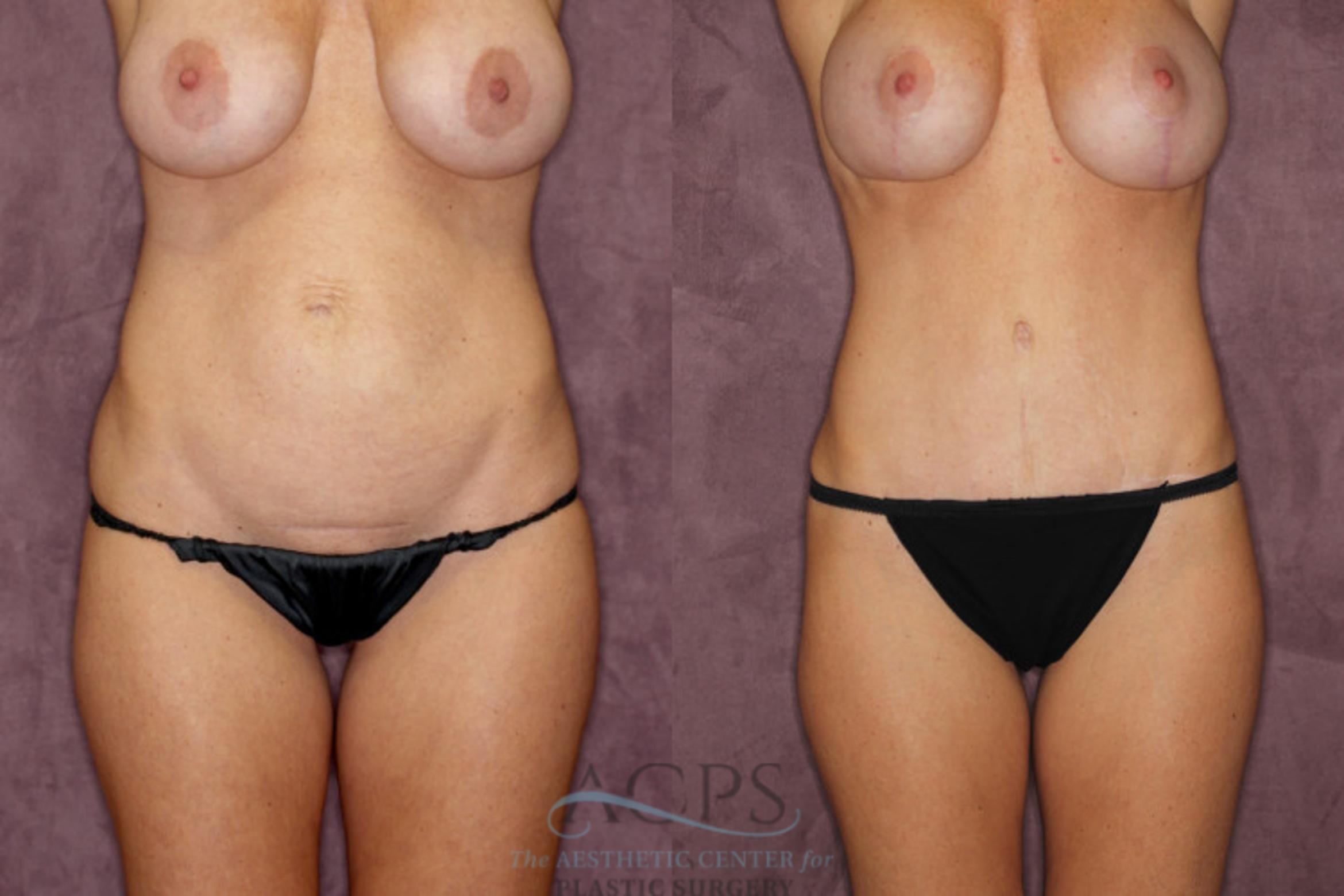 Before & After Tummy Tuck Case 64 Front View: View in Houston, TX