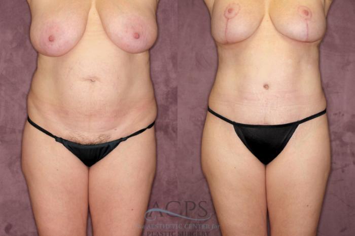 Before & After Tummy Tuck Case 65 Front View: View in Houston, TX