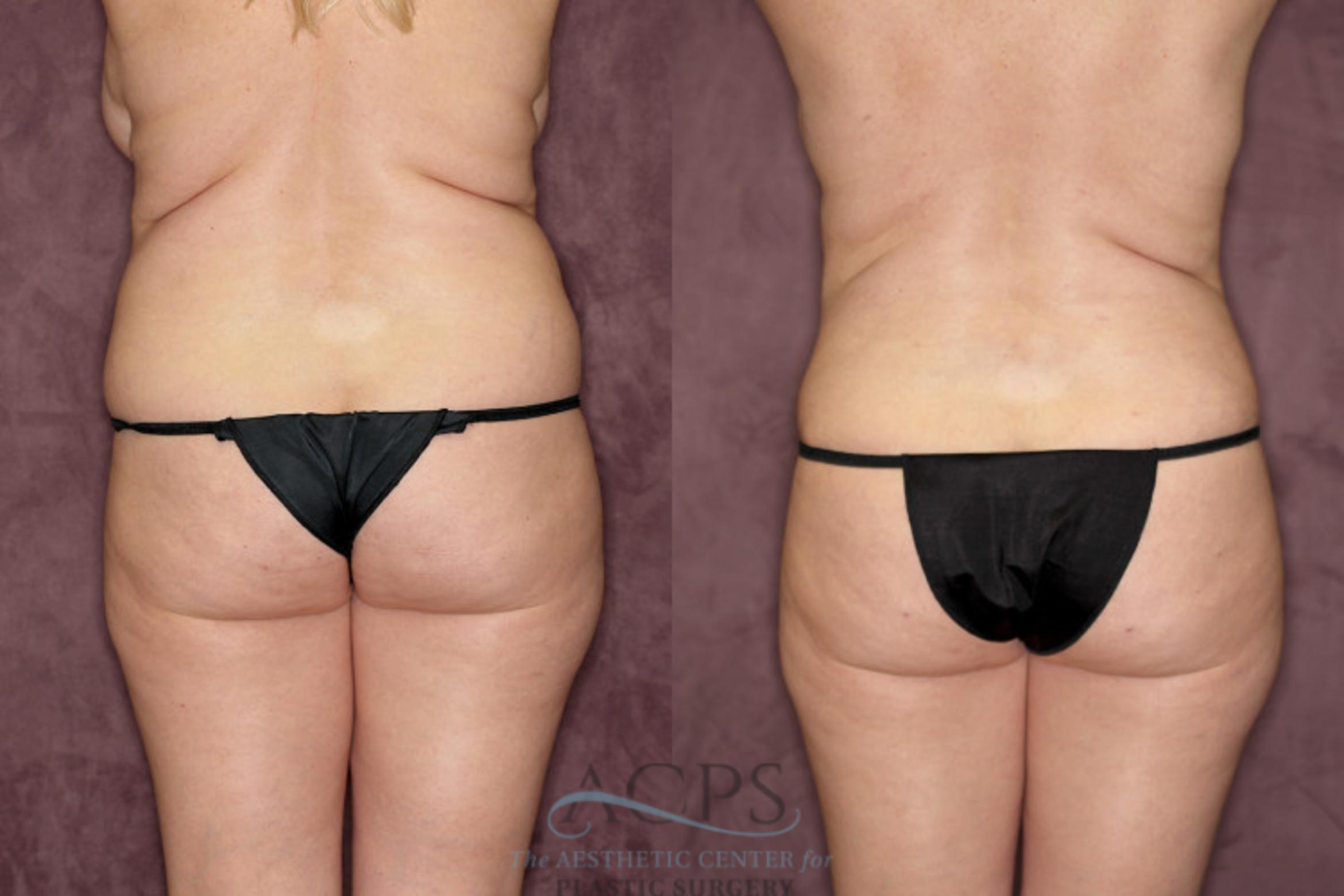 Before & After Tummy Tuck Case 65 Rear View: View in Houston, TX