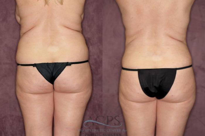Before & After Tummy Tuck Case 65 Rear View: View in Houston, TX