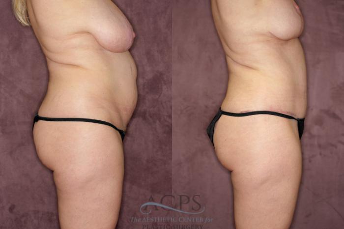 Before & After Tummy Tuck Case 65 Side Right View: View in Houston, TX