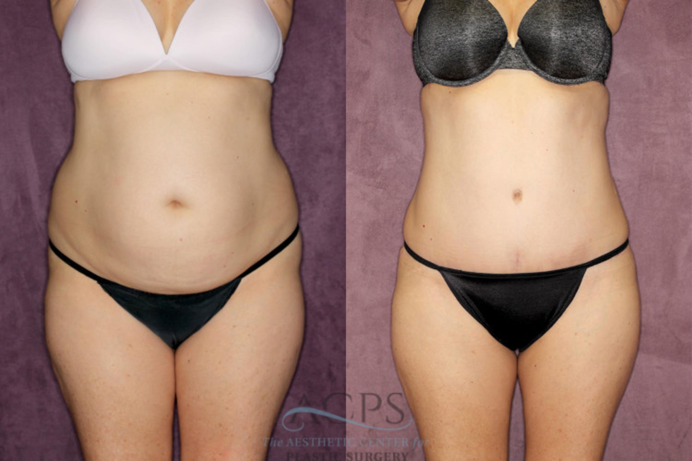 Before & After Liposuction Case 67 Front View: View in Houston, TX