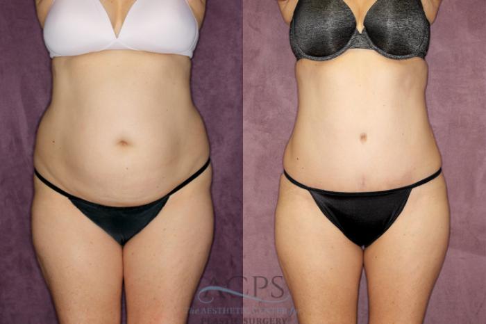 Before & After Liposuction Case 67 Front View: View in Houston, TX