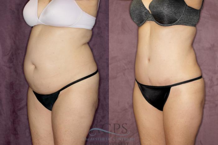 Before & After Liposuction Case 67 Oblique Left View: View in Houston, TX