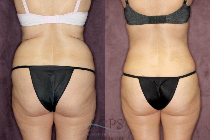 Before & After Liposuction Case 67 Rear View: View in Houston, TX
